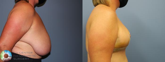 Before & After Breast Reduction Case 11928 Right Side View in Golden, CO