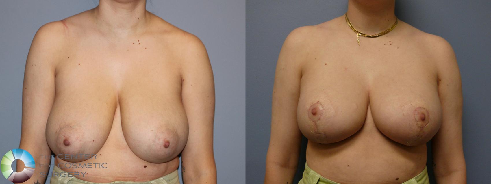 Before & After Breast Reduction Case 11929 Front in Denver and Colorado Springs, CO