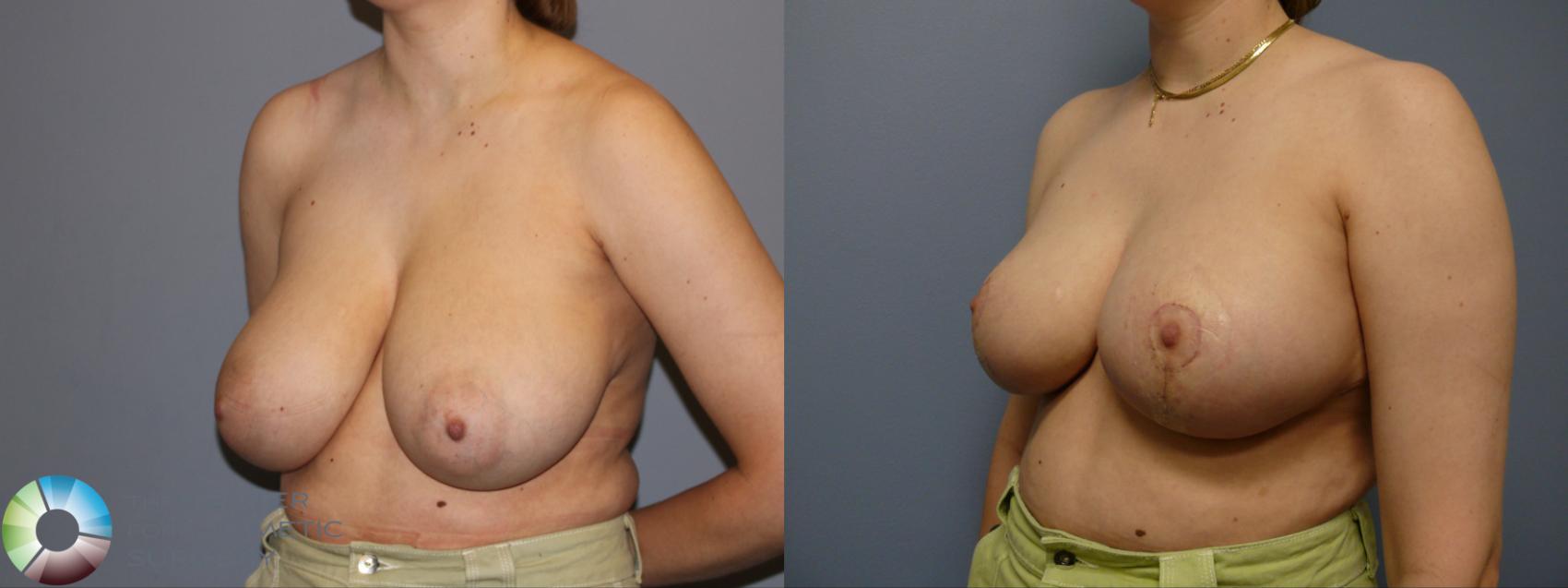 Before & After Breast Reduction Case 11929 Left Oblique View in Golden, CO
