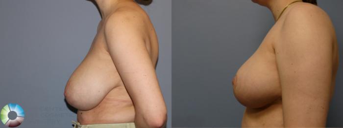 Before & After Breast Reduction Case 11929 Left Side View in Golden, CO
