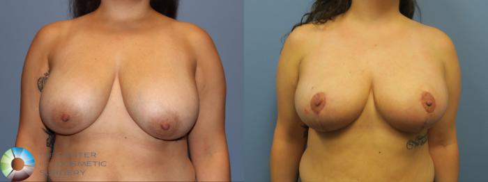Before & After Breast Reduction Case 11930 Front View in Golden, CO