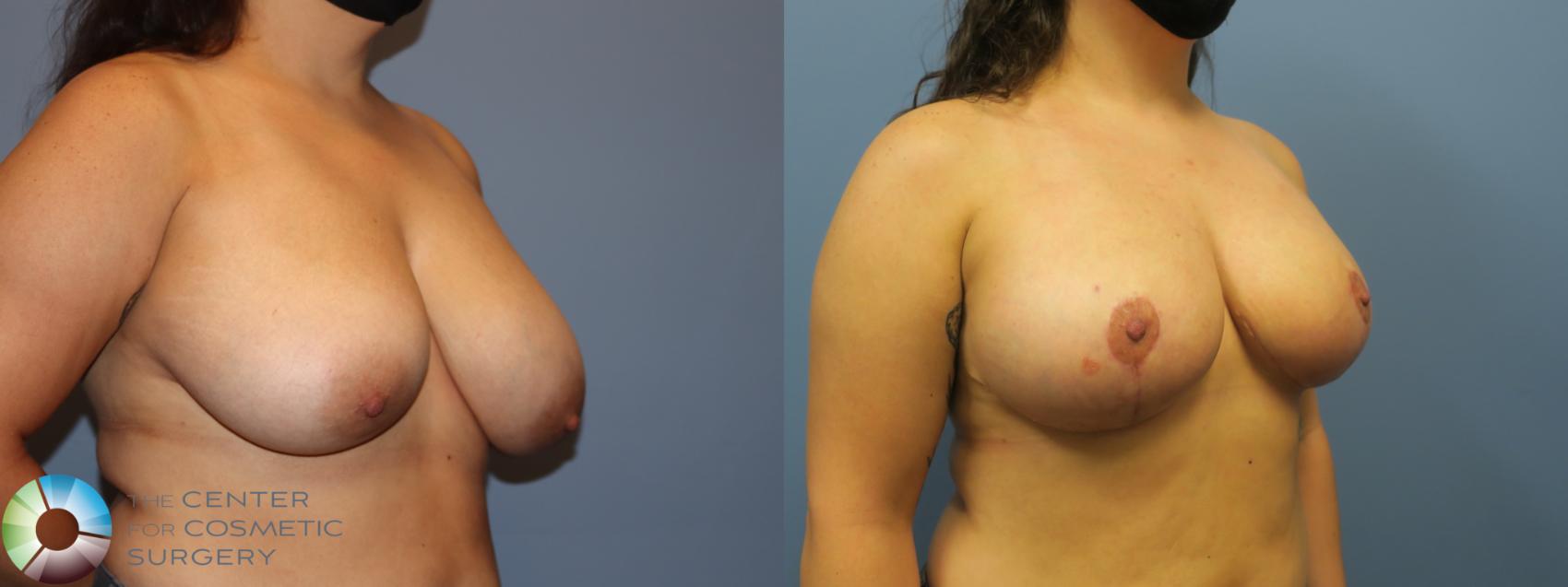 Before & After Breast Reduction Case 11930 Right Oblique in Denver and Colorado Springs, CO