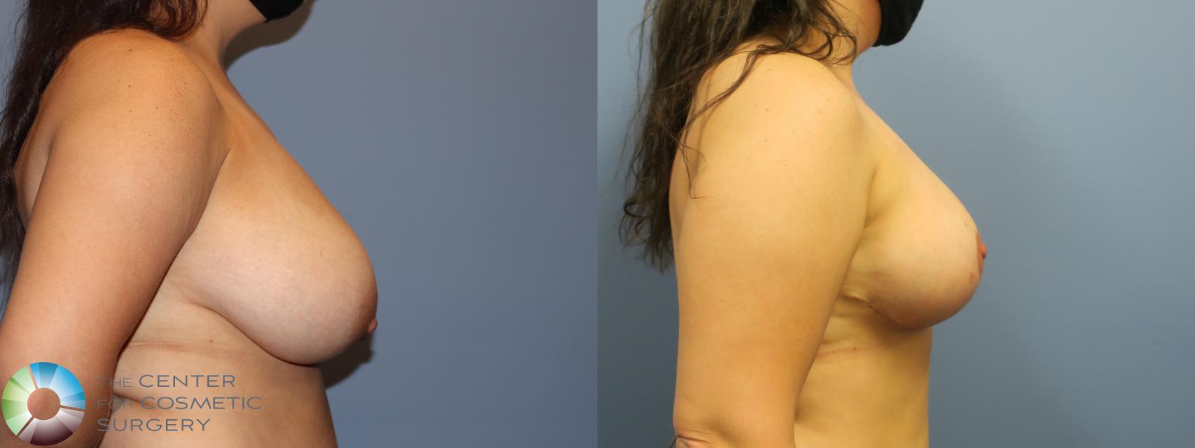 Before & After Breast Reduction Case 11930 Right Side in Denver and Colorado Springs, CO