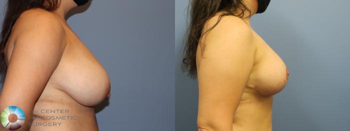 Before & After Breast Reduction Case 11930 Right Side View in Golden, CO