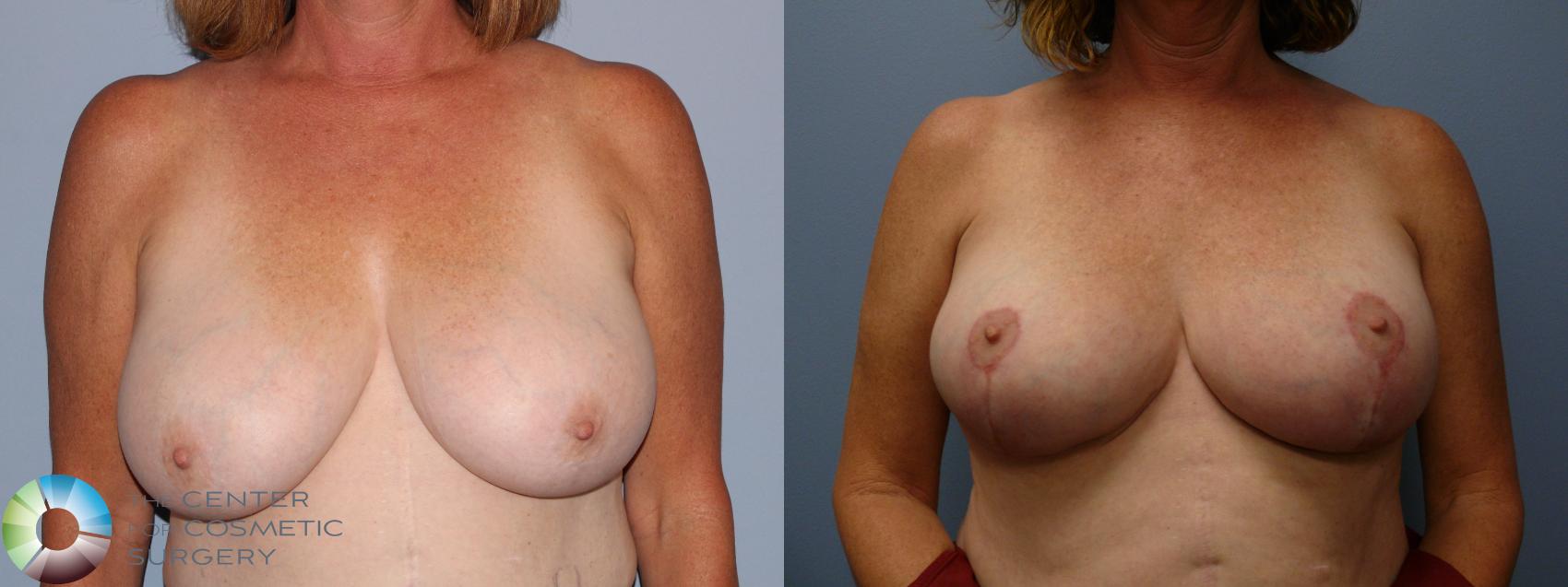 Before & After Breast Reduction Case 11931 Front in Denver and Colorado Springs, CO