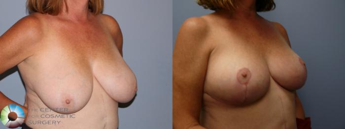 Before & After Breast Reduction Case 11931 Right Oblique in Denver and Colorado Springs, CO