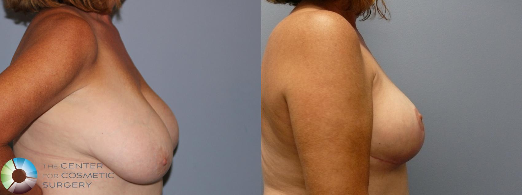 Before & After Breast Reduction Case 11931 Right Side in Denver and Colorado Springs, CO