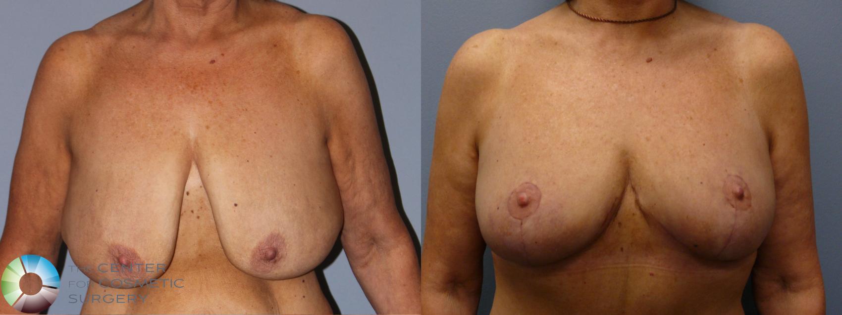 Before & After Breast Reduction Case 11938 Front in Denver and Colorado Springs, CO