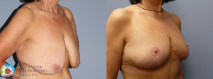 Before & After Breast Reduction Case 11938 Right Oblique in Denver and Colorado Springs, CO