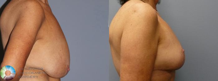 Before & After Breast Reduction Case 11938 Right Side in Denver and Colorado Springs, CO