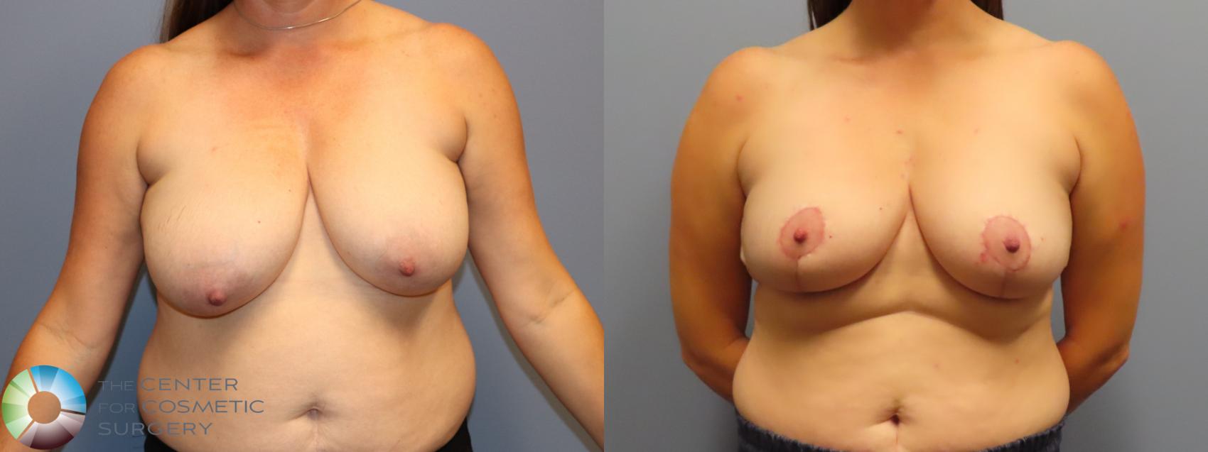 Before & After Breast Reduction Case 11947 Front in Denver and Colorado Springs, CO