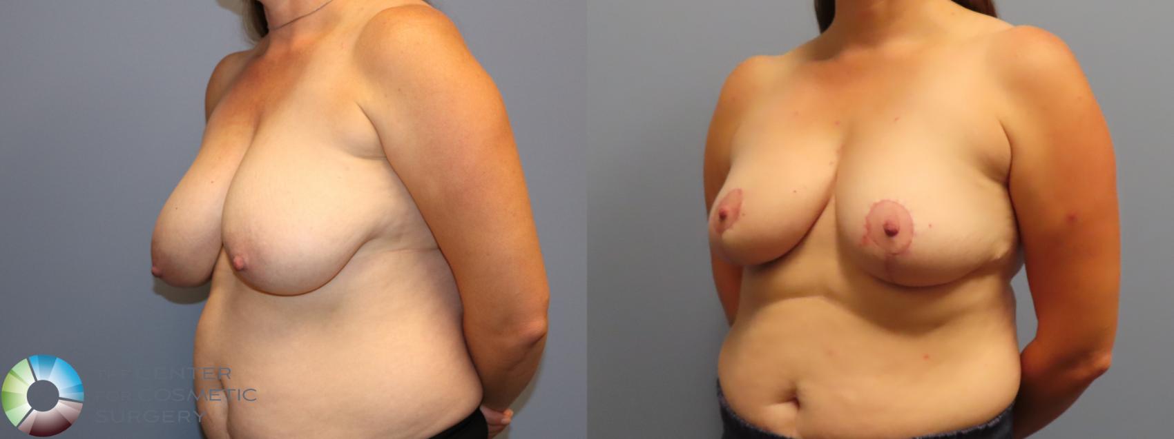 Before & After Breast Reduction Case 11947 Left Oblique in Denver and Colorado Springs, CO