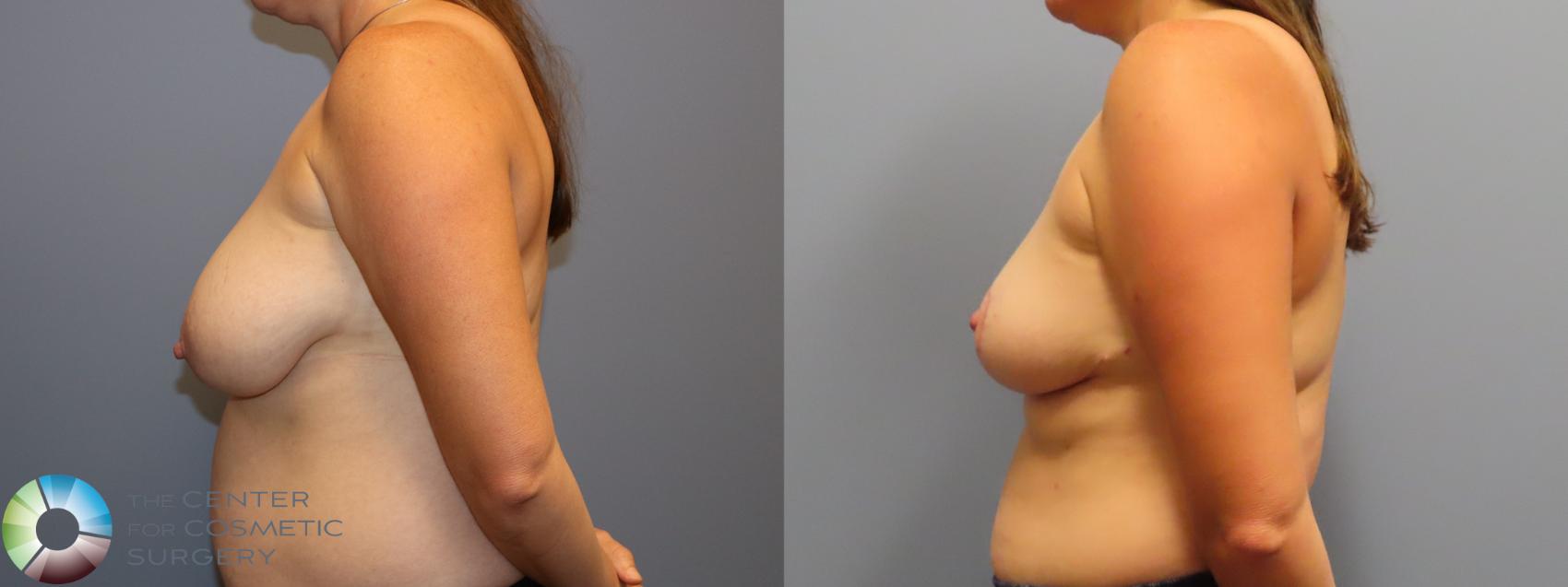Before & After Breast Reduction Case 11947 Left Side View in Golden, CO