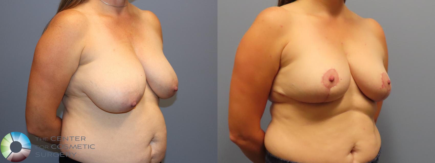 Before & After Breast Reduction Case 11947 Right Oblique in Denver and Colorado Springs, CO