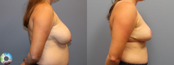 Before & After Breast Reduction Case 11947 Right Side View in Golden, CO