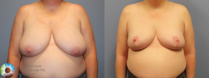 Before & After Breast Reduction Case 11950 Front in Denver and Colorado Springs, CO