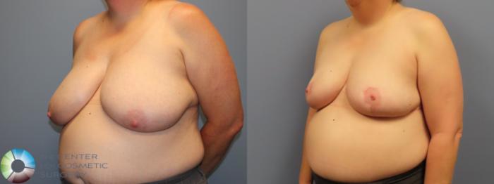 Before & After Breast Reduction Case 11950 Left Oblique in Denver and Colorado Springs, CO