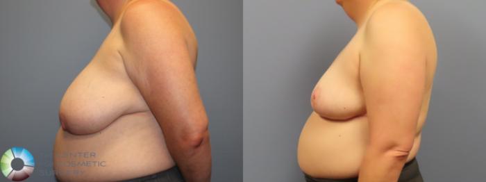 Before & After Breast Reduction Case 11950 Left Side in Denver and Colorado Springs, CO