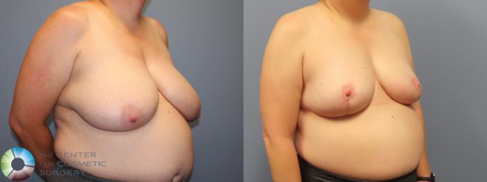 Before & After Breast Reduction Case 11950 Right Oblique in Denver and Colorado Springs, CO