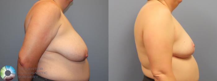 Before & After Breast Reduction Case 11950 Right Side in Denver and Colorado Springs, CO