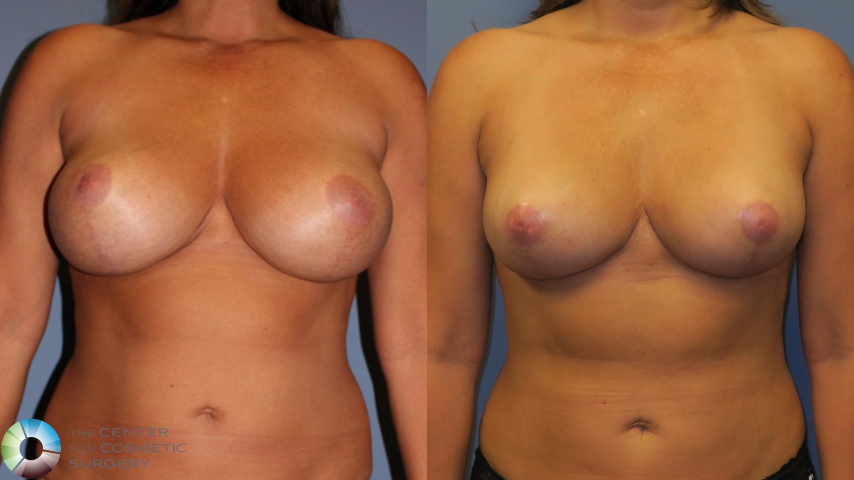 Before & After Breast Reduction Case 11963 Front in Denver and Colorado Springs, CO