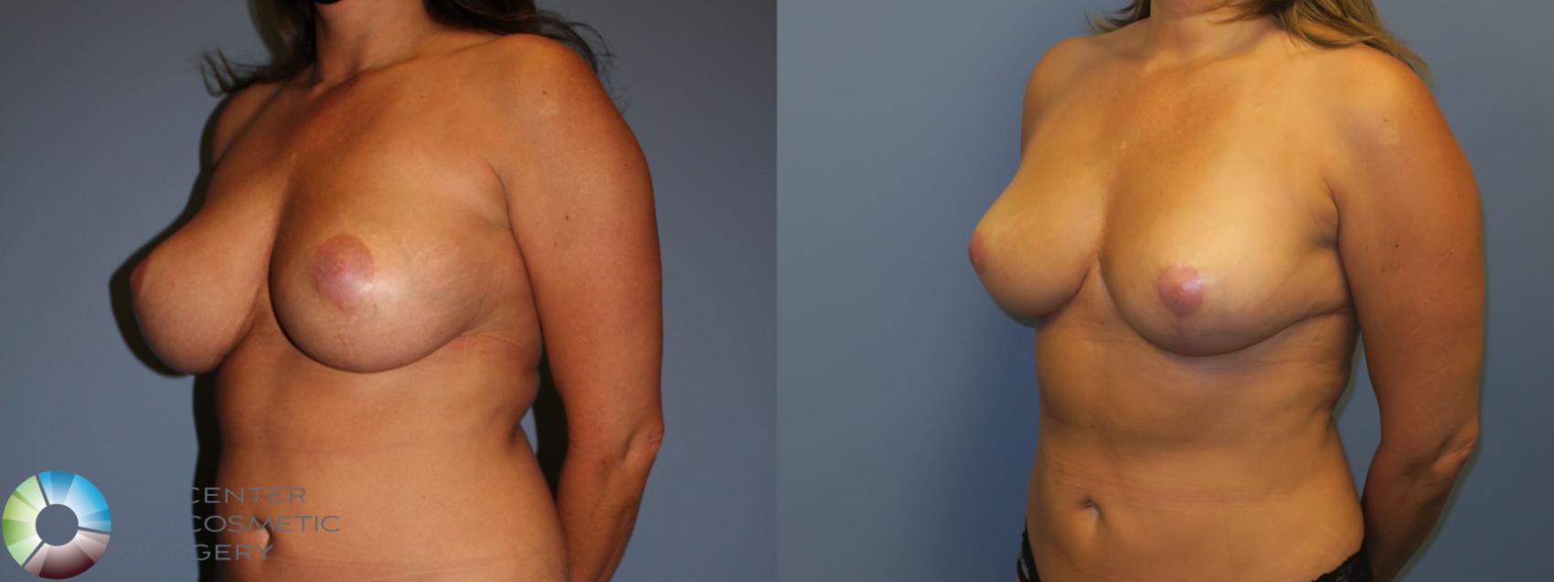 Before & After Breast Reduction Case 11963 Left Oblique in Denver and Colorado Springs, CO