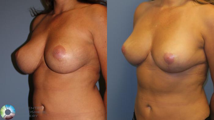 Before & After Breast Reduction Case 11963 Left Oblique in Denver and Colorado Springs, CO