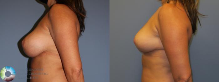 Before & After Breast Reduction Case 11963 Left Side in Denver and Colorado Springs, CO