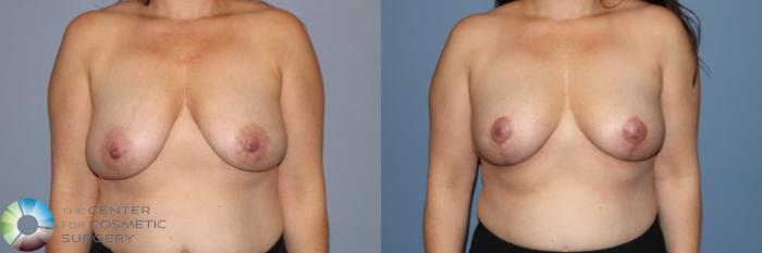 Before & After Breast Reduction Case 11964 Front in Denver and Colorado Springs, CO