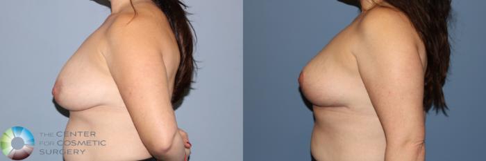 Before & After Breast Reduction Case 11964 Left Side in Denver and Colorado Springs, CO