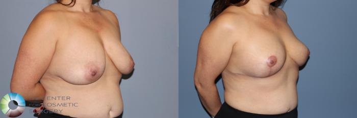Before & After Breast Reduction Case 11964 Right Oblique in Denver and Colorado Springs, CO