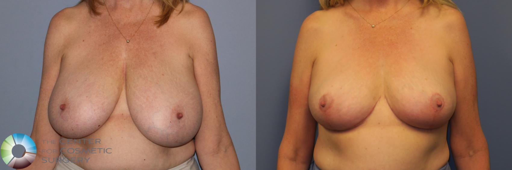 Before & After Breast Reduction Case 11965 Front in Denver and Colorado Springs, CO