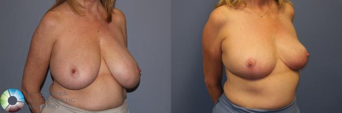 Before & After Breast Reduction Case 11965 Right Oblique in Denver and Colorado Springs, CO