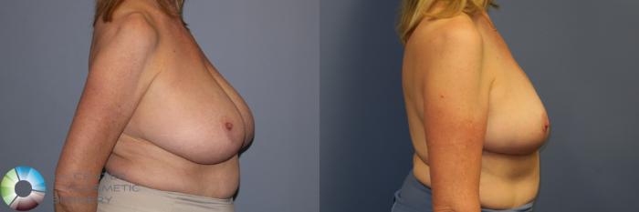Before & After Breast Reduction Case 11965 Right Side in Denver and Colorado Springs, CO