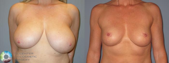 Before & After Breast Reduction Case 11966 Front in Denver and Colorado Springs, CO