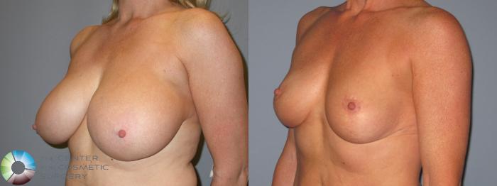 Before & After Breast Reduction Case 11966 Left Oblique in Denver and Colorado Springs, CO