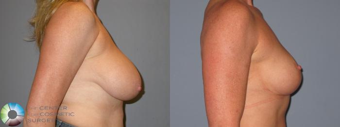 Before & After Breast Reduction Case 11966 Right Side in Denver and Colorado Springs, CO