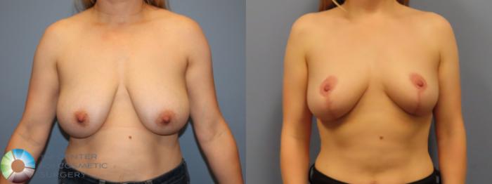 Before & After Breast Reduction Case 11969 Front in Denver and Colorado Springs, CO