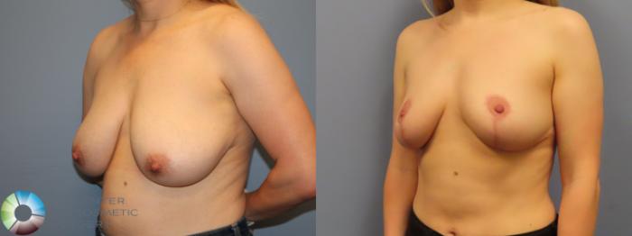 Before & After Breast Reduction Case 11969 Left Oblique in Denver and Colorado Springs, CO