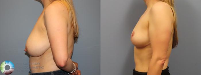 Before & After Breast Reduction Case 11969 Left Side in Denver and Colorado Springs, CO