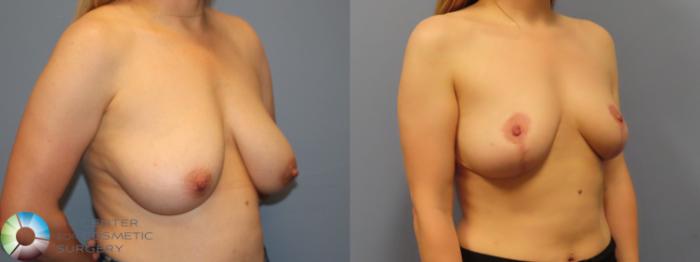 Before & After Breast Reduction Case 11969 Right Oblique in Denver and Colorado Springs, CO