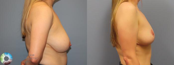 Before & After Breast Reduction Case 11969 Right Side in Denver and Colorado Springs, CO