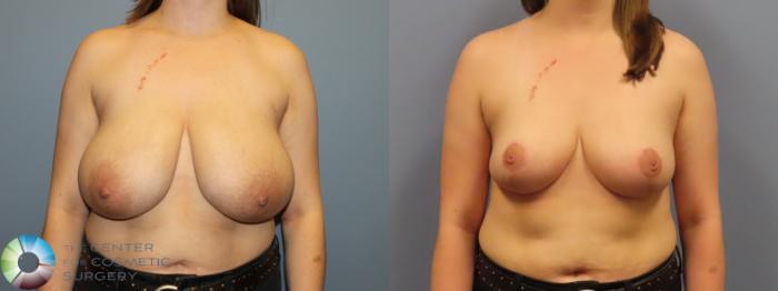 Before & After Breast Reduction Case 12005 Front in Denver and Colorado Springs, CO