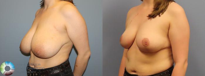 Before & After Breast Reduction Case 12005 Left Oblique in Denver and Colorado Springs, CO