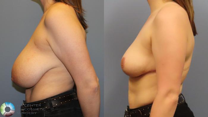 Before & After Breast Reduction Case 12005 Left Side in Denver and Colorado Springs, CO