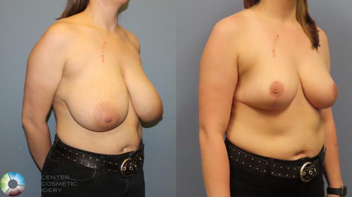 Before & After Breast Reduction Case 12005 Right Oblique in Denver and Colorado Springs, CO