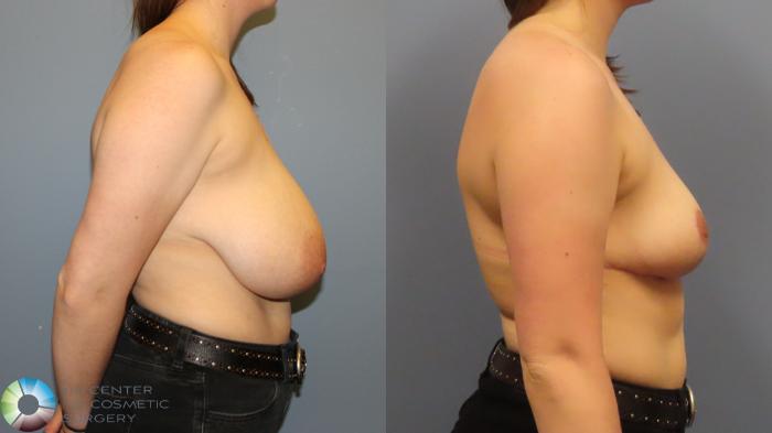 Before & After Breast Reduction Case 12005 Right Side in Denver and Colorado Springs, CO