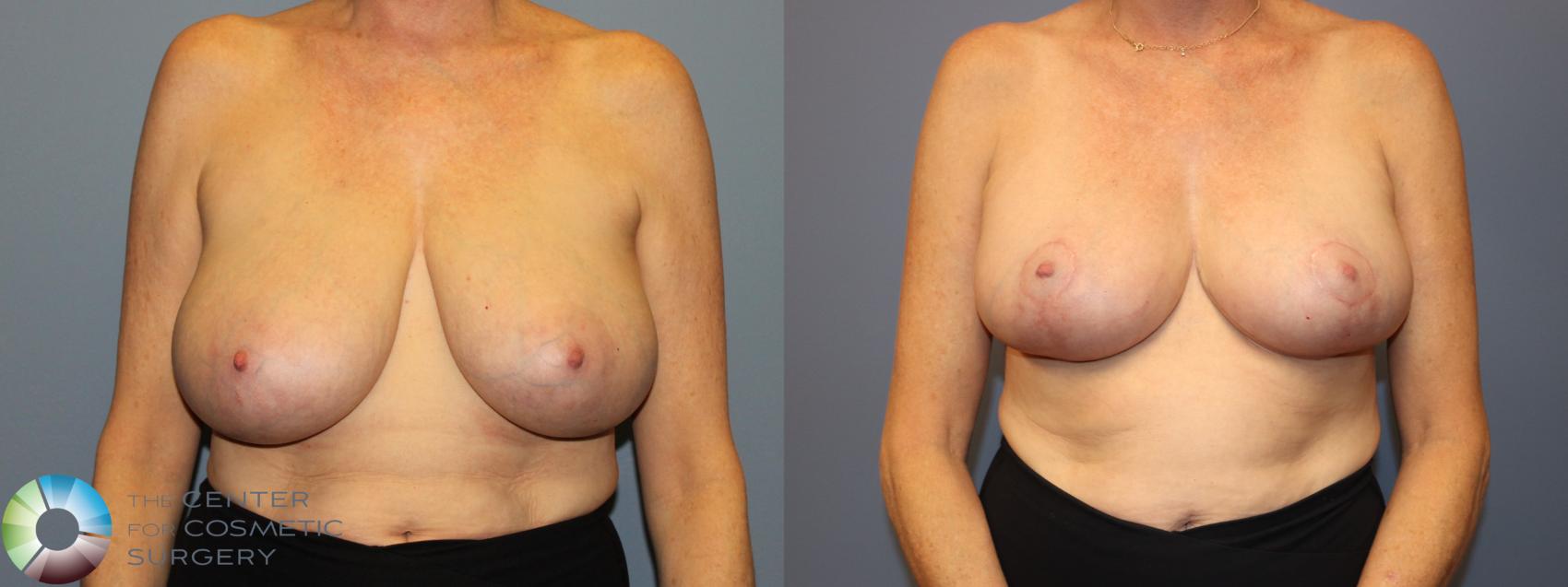 Before & After Breast Reduction Case 12016 Front in Denver and Colorado Springs, CO