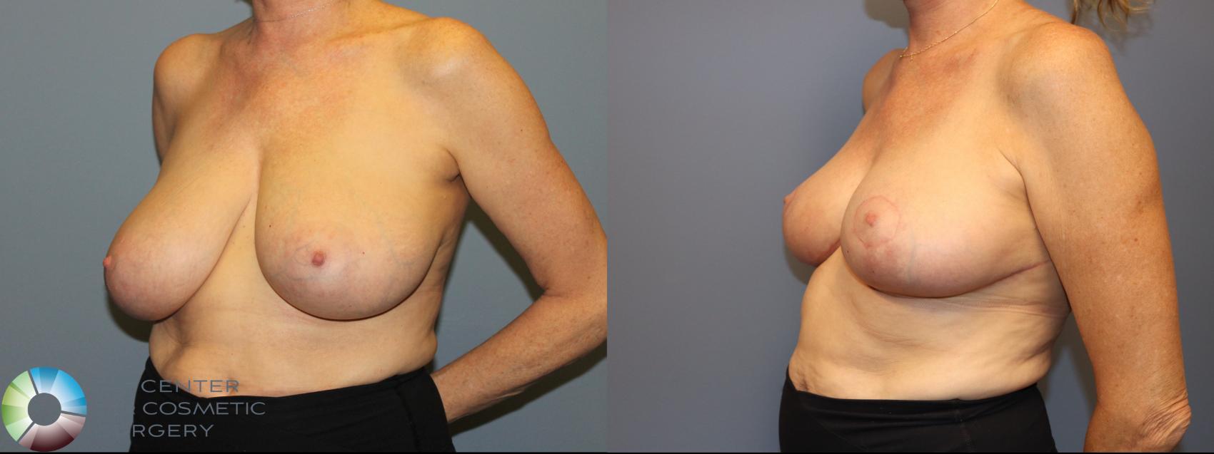 Before & After Breast Reduction Case 12016 Left Oblique in Denver and Colorado Springs, CO