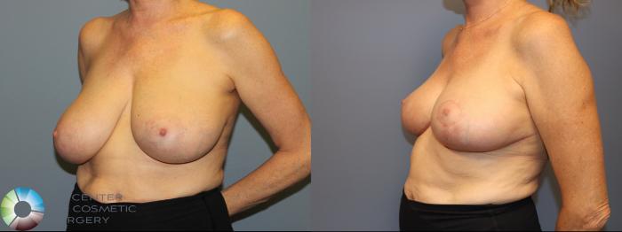 Before & After Breast Reduction Case 12016 Left Oblique in Denver and Colorado Springs, CO